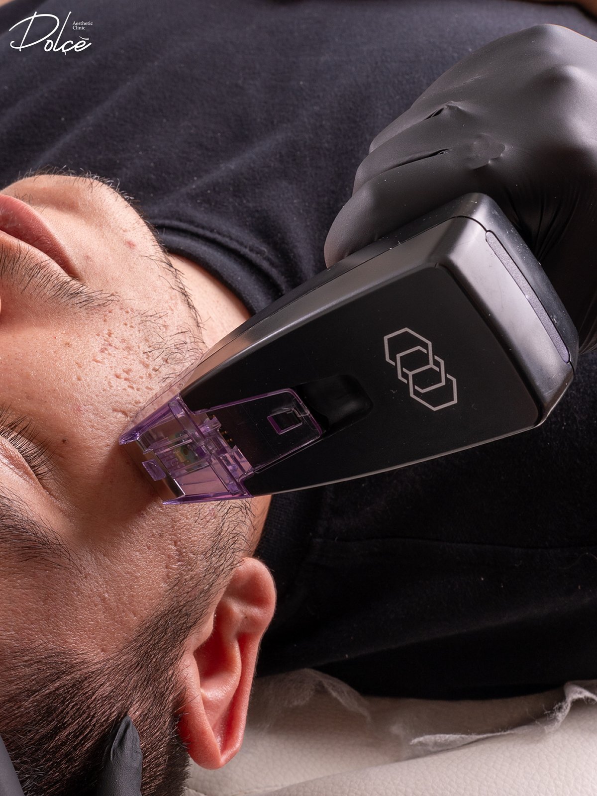 Morpheus8 treatment at Dolce
